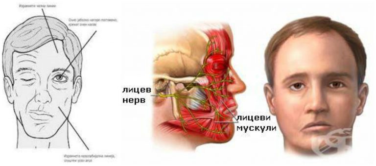 БЕЛОВА ПАРАЛИЗА ИЛИ ПАРЕЗА НА ЛИЦЕВИОТ НЕРВ